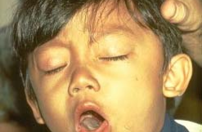 PHOTO: Young boy coughing from Pertussis also known as whooping cough