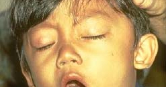 PHOTO: Young boy coughing from Pertussis also known as whooping cough