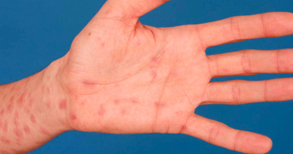 Streamline: Congenital Syphilis on the Rise, Requires Increase in Index of Suspicion